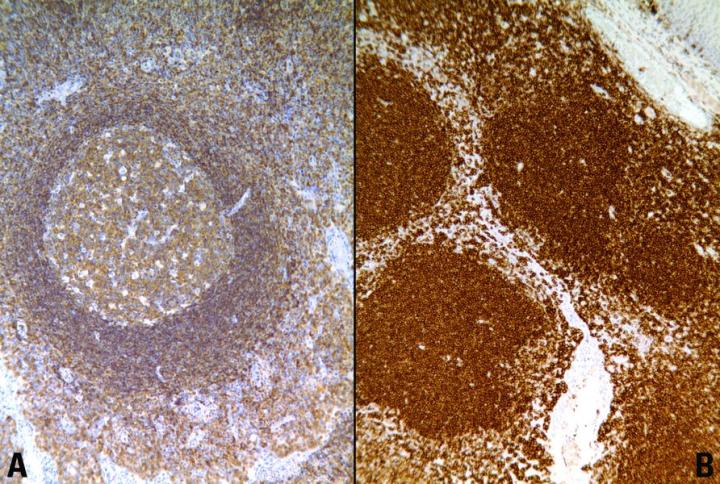 Figure 2. LCA (CD45) staining on reactive tonsil. A. Block fixed for 3 hours in 10% formal saline showing weak demonstration of lymphocytes. B. Block fixed for 8 hours in 10% formal saline showing strong staining of lymphocytes.