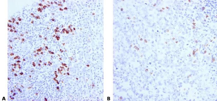 A. shows ISH for kappa light chain mRNA on well-fixed tonsil, this view shows a sharp, strong reaction. B. shows ISH for kappa light chain mRNA on poorly fixed tonsil illustrating a weak reaction.