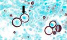 HISTOPLASMOSIS WITH GMS