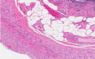 The H&E stain. This is a microscopic image (micrograph) of a paraffin section of the wall of a human appendix taken using brightfield microscopy. Cell nuclei are stained blue, while smooth muscle, collagen, and other components are stained in shades of pink. The large clear spaces belong to fat cells, the fat having been dissolved out during processing.